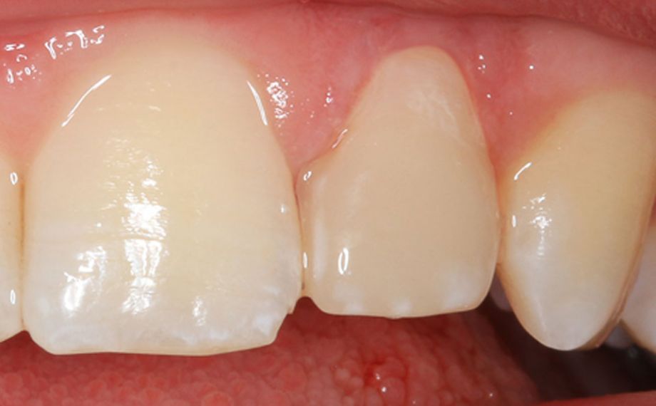 Exemple 2Ill. 4 : Résultat : La restauration en céramique hybride s'intégrait de manière étonnante dans la dentition naturelle.