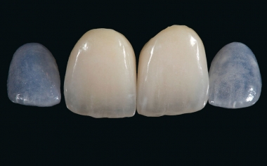 Ill. 12 : Résultat final après finition, caractérisation et glaçage avec VITA AKZENT Plus et polissage.