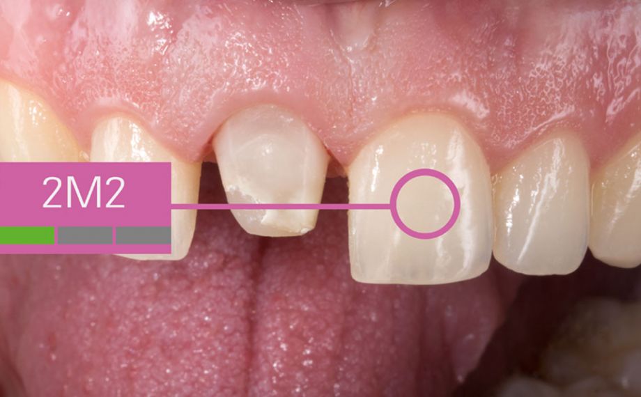 Fig. 6: Il colore del dente contiguo è stato integrato in una fotografia digitale inviata al laboratorio.