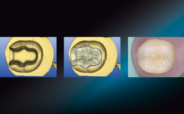 Fig. 1: Nella cavità del dente test sono stati fissati provvisoriamenre con glicerina in gel inlays in differenti materiali CAD/CAM.
