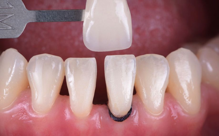 Fig. 2: Il colore determinato con la VITA Toothguide 3D-MASTER rientrava nello spazio cromatico dei denti naturali e ha permesso la scelta del corretto blocchetto.