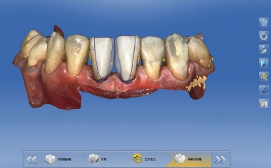 Fig. 4: Progettazione delle faccette Non-Prep nel software CEREC Premium 4.4.4.