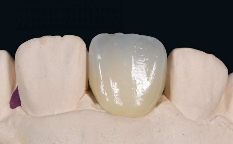 Fig. 8: Già sul modello il restauro monolitico ha un aspetto assolutamente naturale.