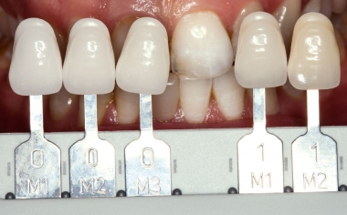 Fig. 2: Con la VITA Linearguide 3D-MASTER si è determinato esattamente il colore dei denti e selezionato il corrispondente blocchetto di colore 0M1.