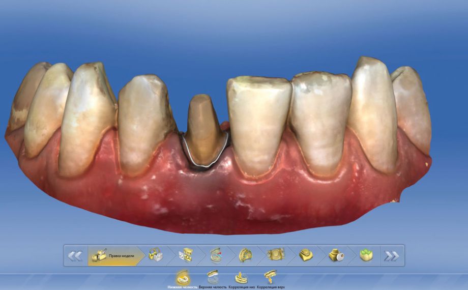 Fig. 7: Anche nella preparazione per una corona integrale su 41 il limite della stessa è stato definito in modalità digitale.