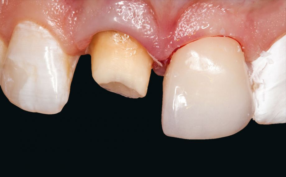 Fig. 9: Previo precondizionamento, per prima è stata incorporata con metodo adesivo la faccetta individualizzata in VITABLOCS Mark II.