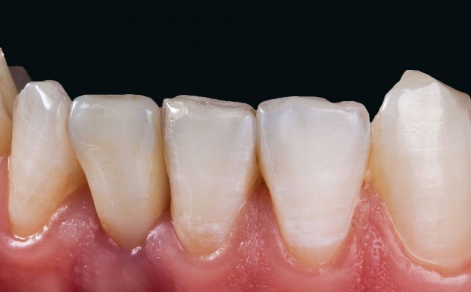 Fig. 12: La corona integralmente in VITA SUPRINITY PC si inserisce perfettamente nei tessuti dentari residui per morfologia e colore.