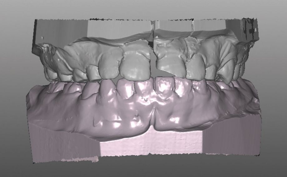 Caso clinico 1Fig. 6: Frattura longitudinale coronale da vestibolare sul modello maestro virtuale. 