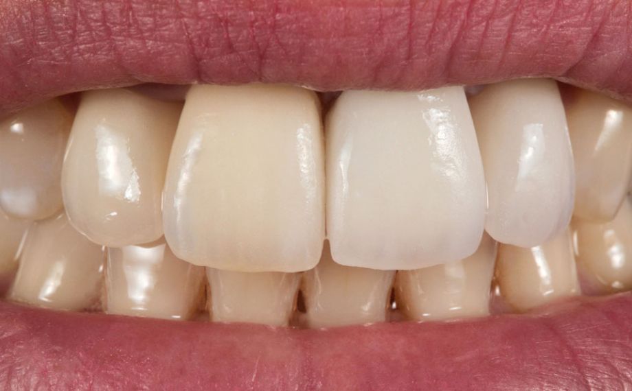 Fig. 4: Inizialmente la cromaticità della corona 21 non si adatta perfettamente nella dentatura residua.