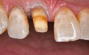 Fig. 1: Situazione iniziale: Per una stabilizzazione durevole il dente 11 è stato preparato per una corona in ceramica integrale.