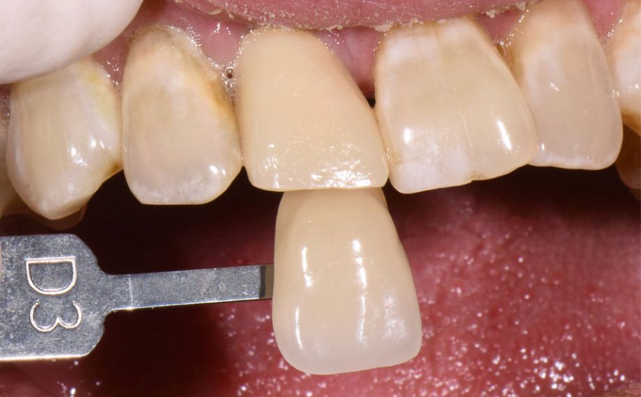 Fig. 2: Il colore base è stato determinato con la scala VITA classical A1–D4.