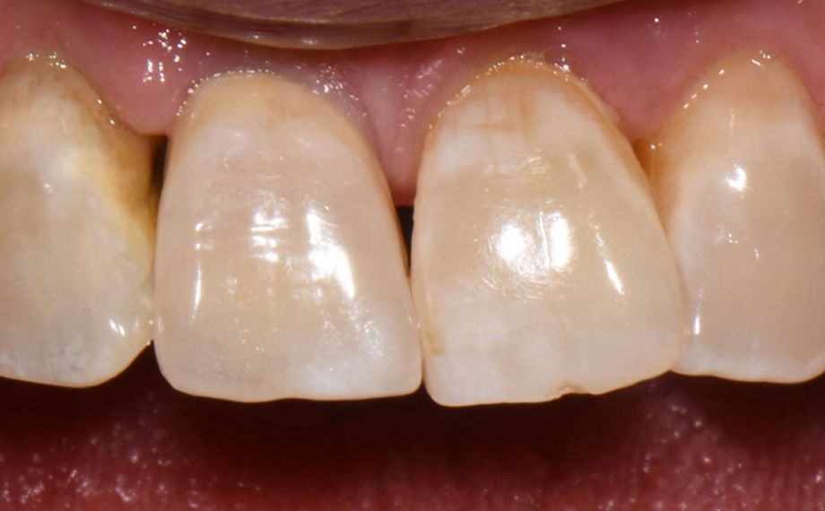 Fig. 7: La corona si integra esteticamente nella dentatura residua.