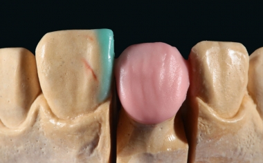Fig. 4: Sul nuceleo dentinale è stata applicata in primo luogo VITA VM 9 BASE DENTINE 1M2.