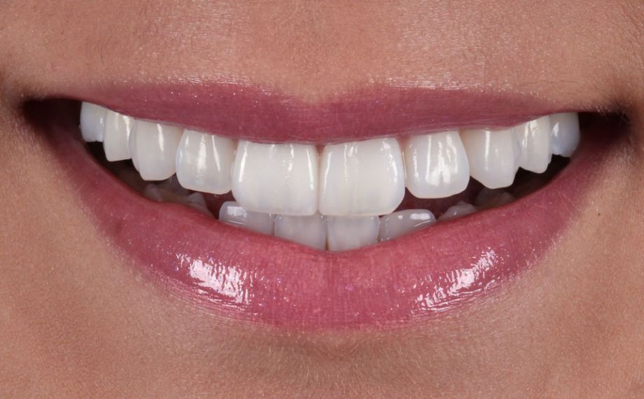 Fig. 10: Nella zona estetica l'arcata dentaria si armonizza con l'andamento labiale.