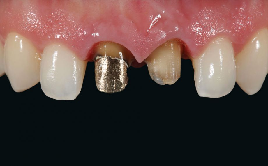 Fig. 5: Dato che l'incisivo 11 è riabilitato con un perno-moncone metallico, si è deciso per strutture coronali in lega non nobile.