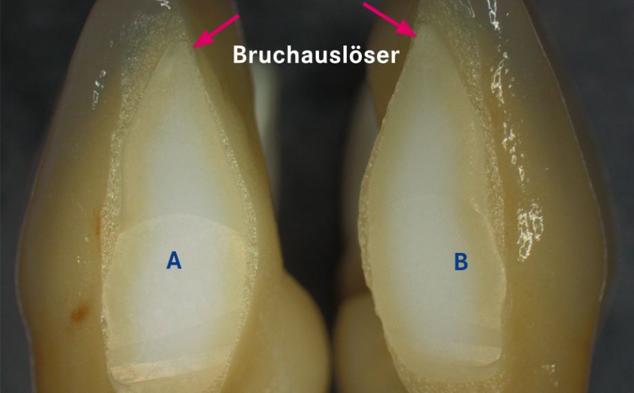 Abb. 1a: Das Gerüst wurde aus ästhetischen Gründen zwischen 31 und 41 nach der Sinterung separiert.