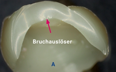 Abb. 2a: Nach Glanzbrand frakturierte glaskeramische Krone.