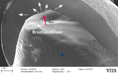 Abb. 2b: Ein mit der Krone „versinterter“ Keramikstift führte beim Herunternehmen der Restauration zu einer Oberflächenschädigung.