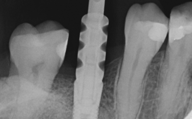 Abb. 4: Das osseointegrierte Implantat mit aufgeschraubtem Abformpfosten.