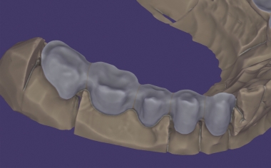 Abb. 2: Das anatomisch reduzierte Brückengerüst in der exocad-Software.