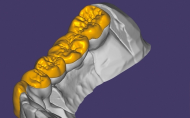 Abb. 5: Palatinal enden die Verblendstrukturen im äquatorialen Bereich der anatomisch reduzierten Gerüstkonstruktion.