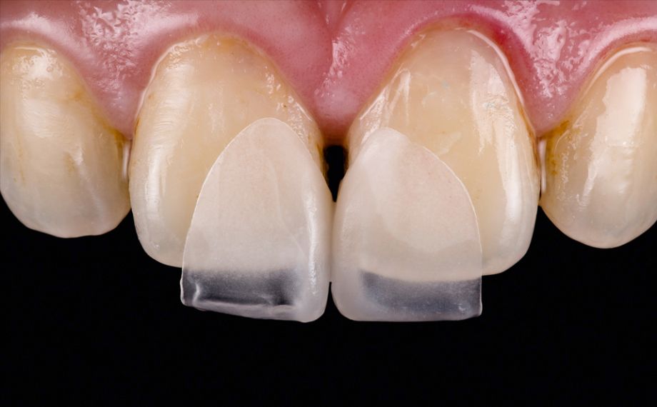 Abb. 4: Die grazilen Microveneers an Zahn 11 und 21 bei der klinischen Einprobe.