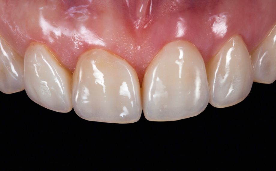 Abb. 15: Die Veneers integrieren sich in die natürlichen Zahnbögen.