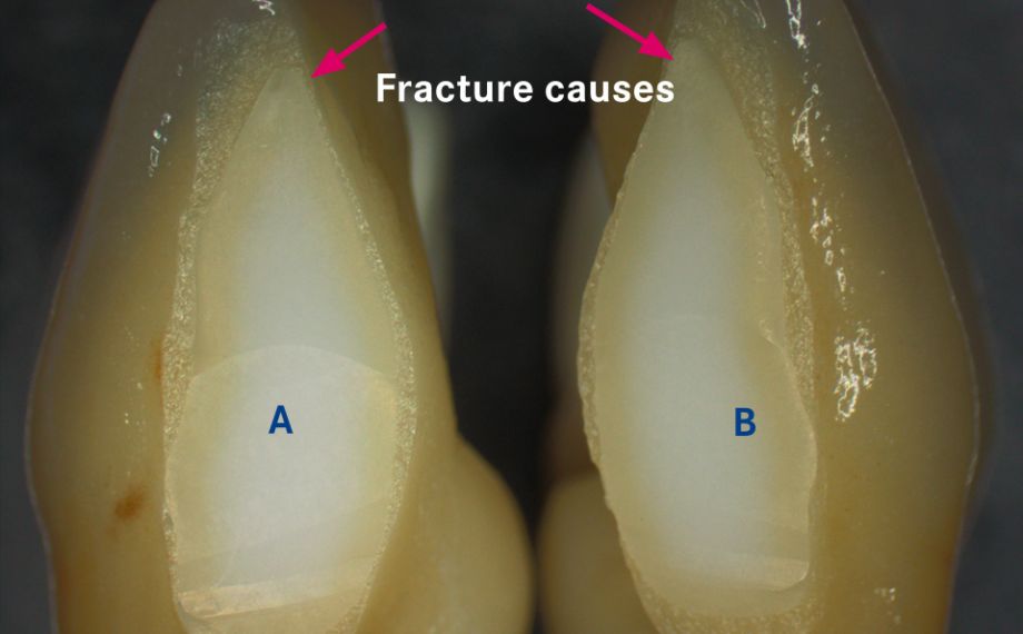 Fig. 1a: The framework was separated between 31 and 41 for esthetic reasons after sintering.