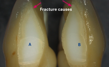 Fig. 1a: The framework was separated between 31 and 41 for esthetic reasons after sintering.