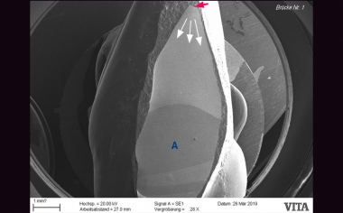 Fig. 1b: Crack formation, which eventually led to the fracture, started from the incisally damaged framework structure.