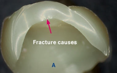 Fig. 2a: Glass ceramic crown fractured following the glaze firing.