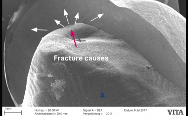 Fig. 2b: A ceramic pin “sintered” with the crown resulted in surface damage when the restoration was removed.