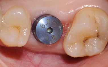 Fig. 1: Initial situation: The implant at 26 after a healing period of three months.