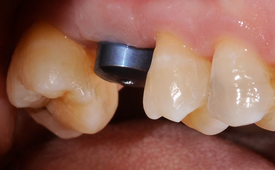 Fig. 2: The soft tissue conditions around the gingiva former were stable and inflammation-free.