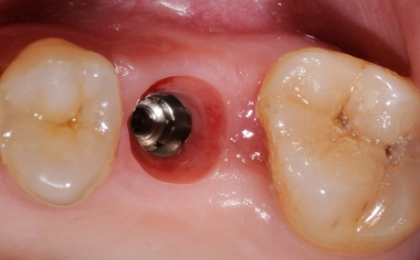 Fig. 3: After the gingiva former was unscrewed, the shaped emergence profile was revealed.