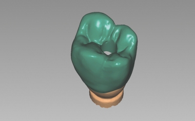 Fig. 6: An abutment crown with screw channel was designed using CAD software.