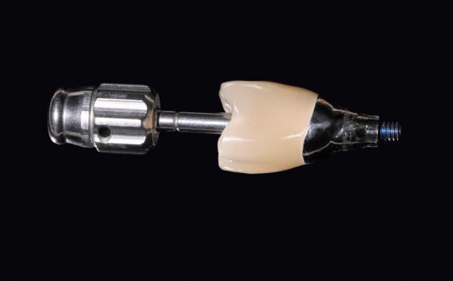 Fig. 9: The abutment crown can be screwed in intraorally via the screw channel.