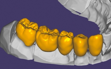 Fig. 4: Thanks to the low minimum wall thicknesses of the hybrid ceramic of up to 0.2 mm, the morphology is very natural.