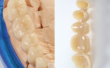 Fig. 7: The completely bonded bridge construction on the model from the occlusal and lumen side.