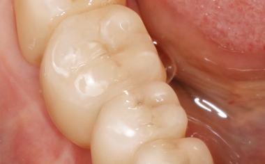 Fig. 8: The final integrated composite bridge from the occlusal side.