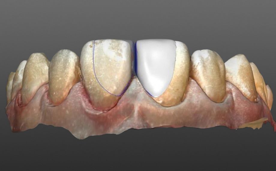 Fig. 2: Razor-thin veneers were constructed using inLab software.