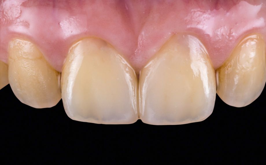 Fig. 6: There was a natural light transmission following the fully adhesive attachment.