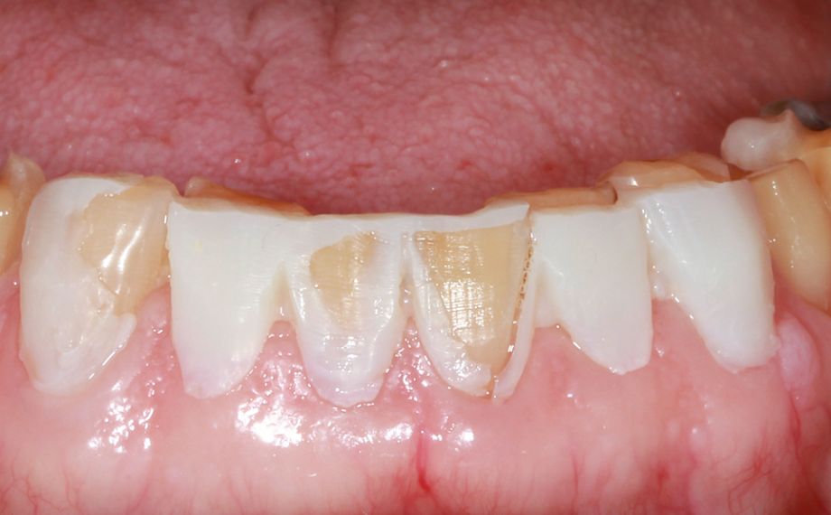 Fig. 6: The substance was removed in a controlled manner and as minimally invasive as possible.