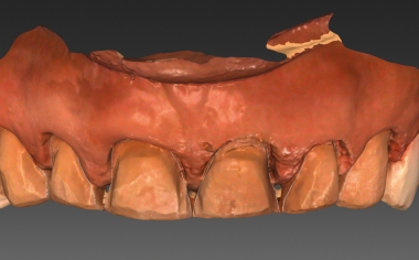 Fig. 7: The scanned preparation in the upper jaw in the CAD software.