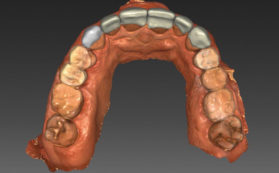 Fig. 8: The virtual construction of the upper jaw veneers from VITABLOCS TriLuxe forte.