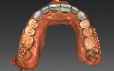 Fig. 8: The virtual construction of the upper jaw veneers from VITABLOCS TriLuxe forte.