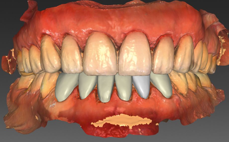 Fig. 9: The virtual construction of the veneers in the lower jaw.