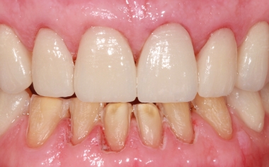 Fig. 11: The veneers produced with CAD/CAM support in the upper jaw immediately after adhesive integration.