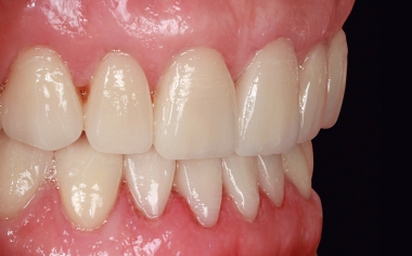 Fig. 12: The veneers in the lower jaw directly after the adhesive integration.