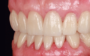 Fig. 13: In the upper jaw, the gingivectomized areas were already healed.